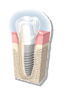implant