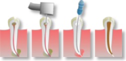 180px-Root_Canal_Illustration